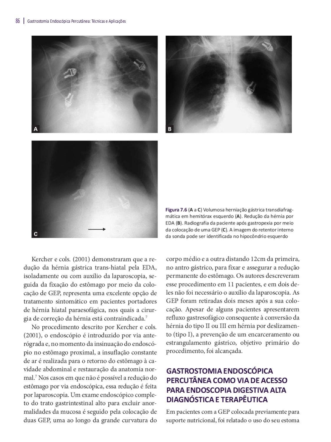 Gastrostomia Endoscópica Percutânea – Técnicas e Aplicações by Editora  Rubio - Issuu, image size:1125x1500