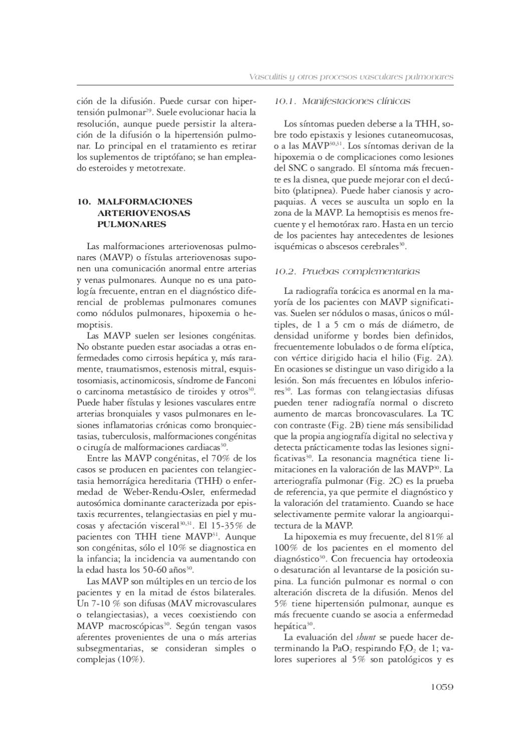 Epistaxis e hipertensión pulmonar