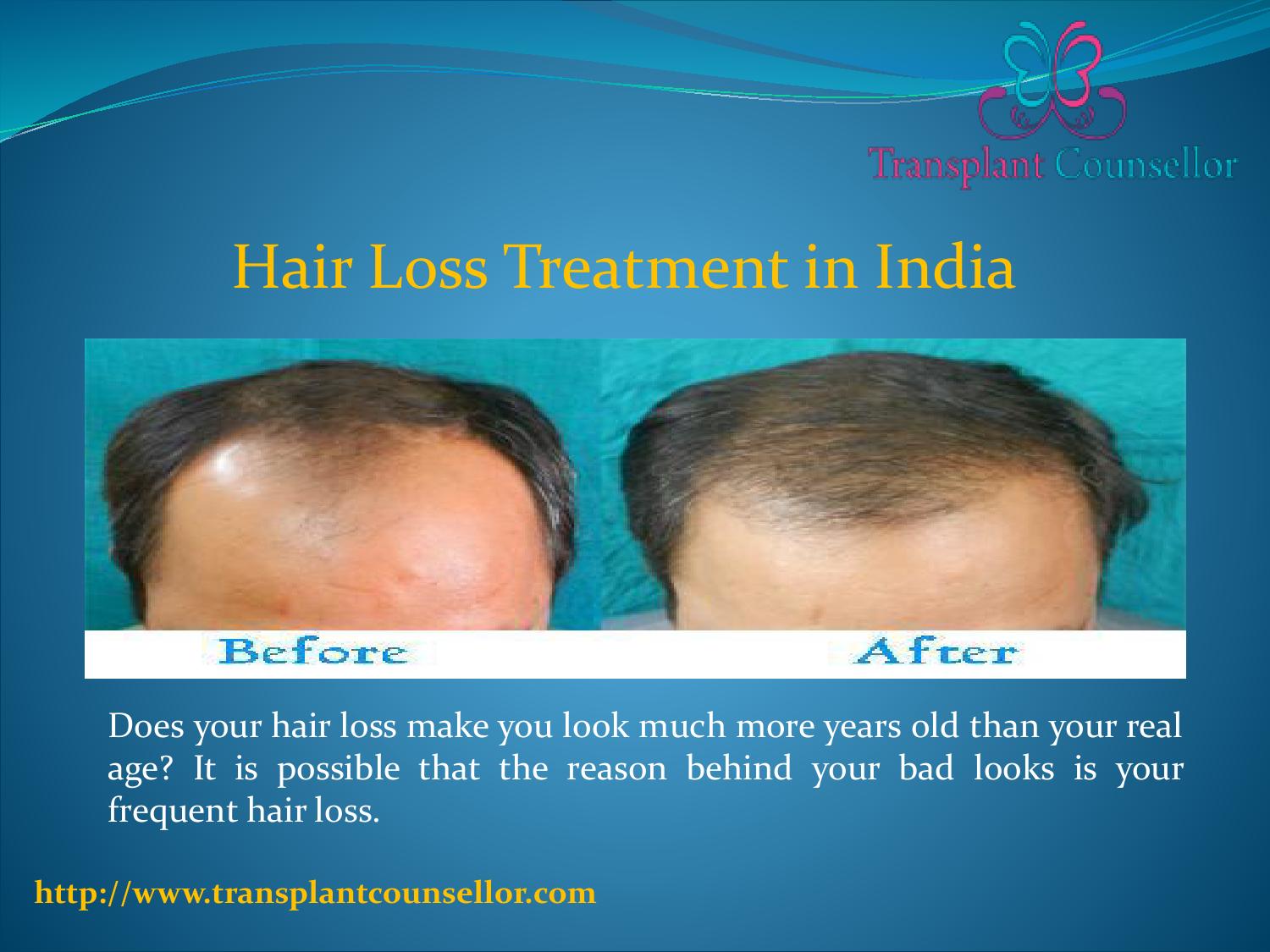 Hair Loss Treatment in India by Yogesh Raj Issuu