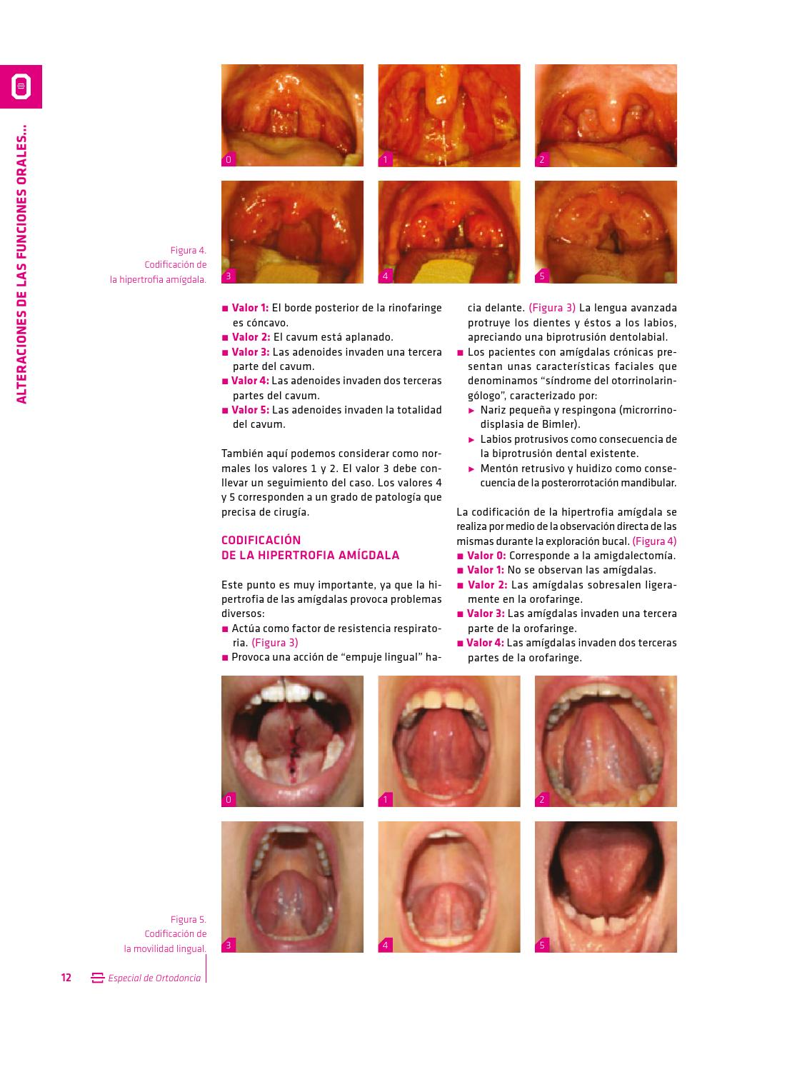 hipertrofia de grado 4