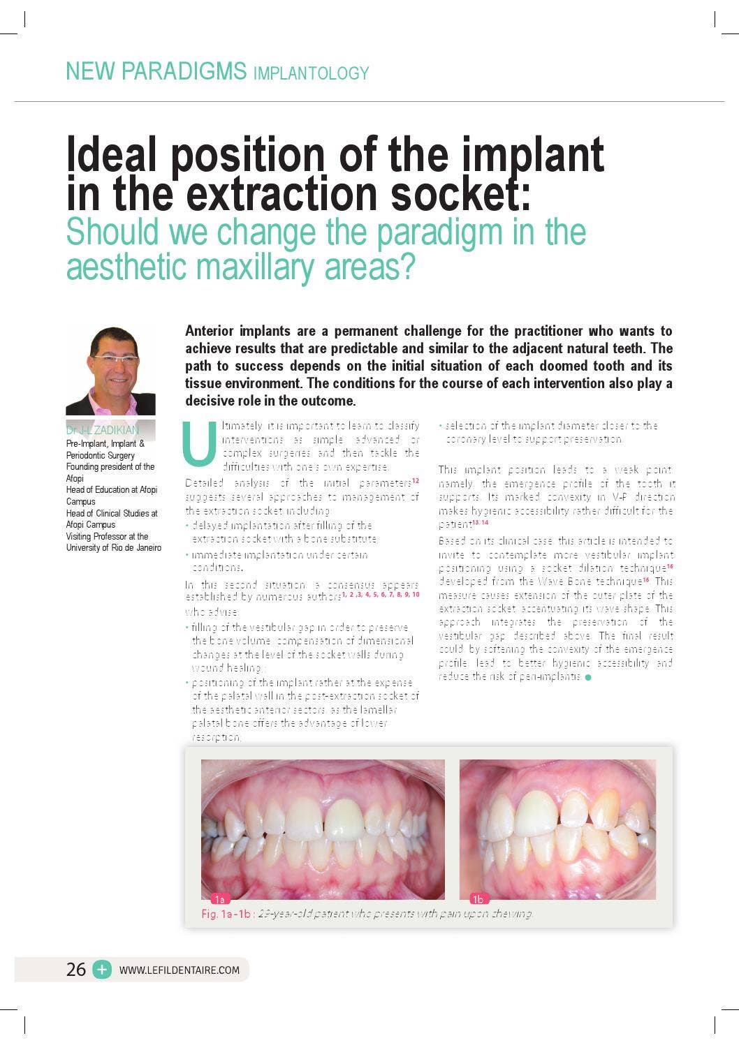 NEW PARADIGMS IMPLANTOLOGY - Ideal position of the implant in the ...