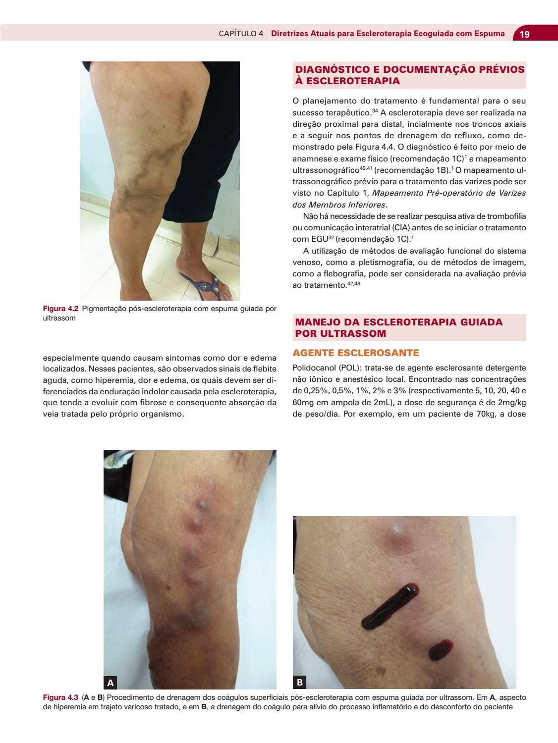 4.3 tratamento de 2 varizes