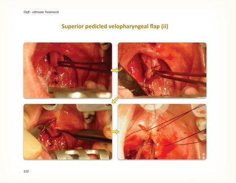 Cleft Ultimate Treatment by IAOMS - Issuu