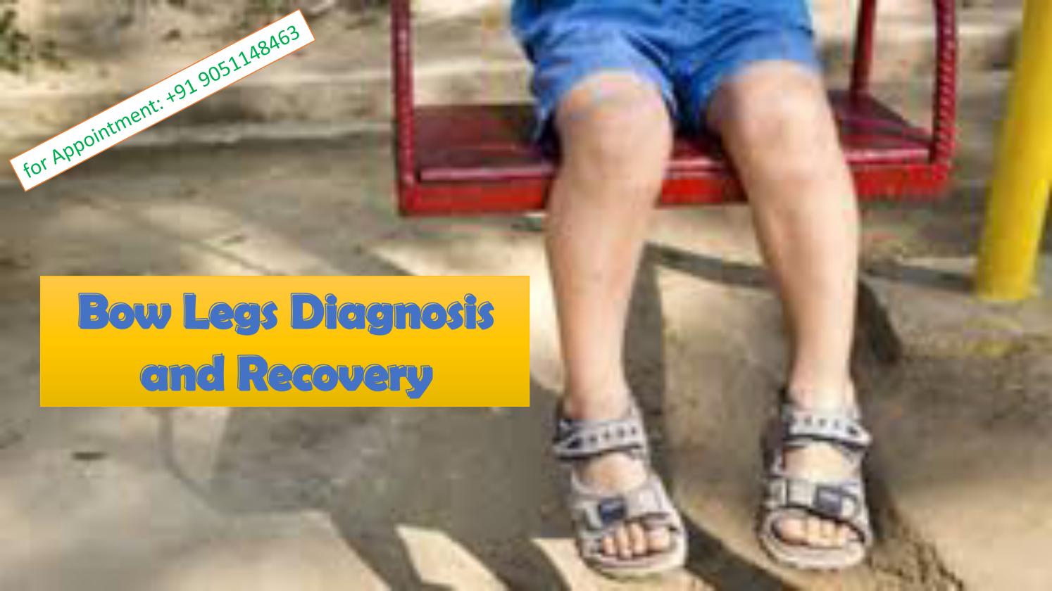 Bow legs diagnosis and recovery by Kids Orthopedic Issuu