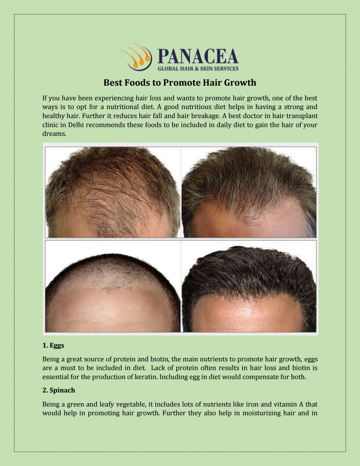 Hair Loss Treatment Hair Transplant Surgery Delhi By Panacea