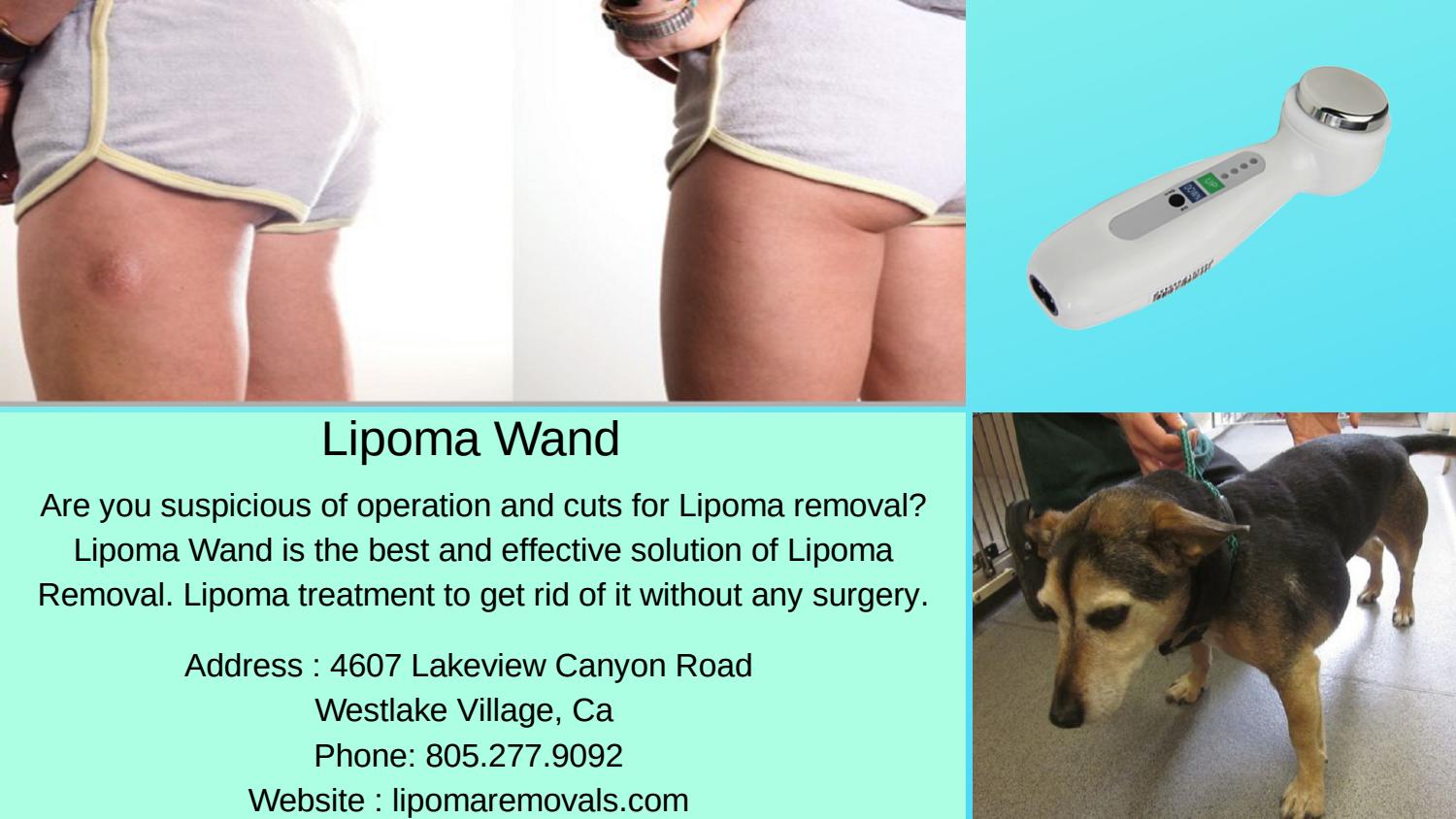 Best Treatment For Lipoma Lipoma Wand By Lipoma Wand Issuu