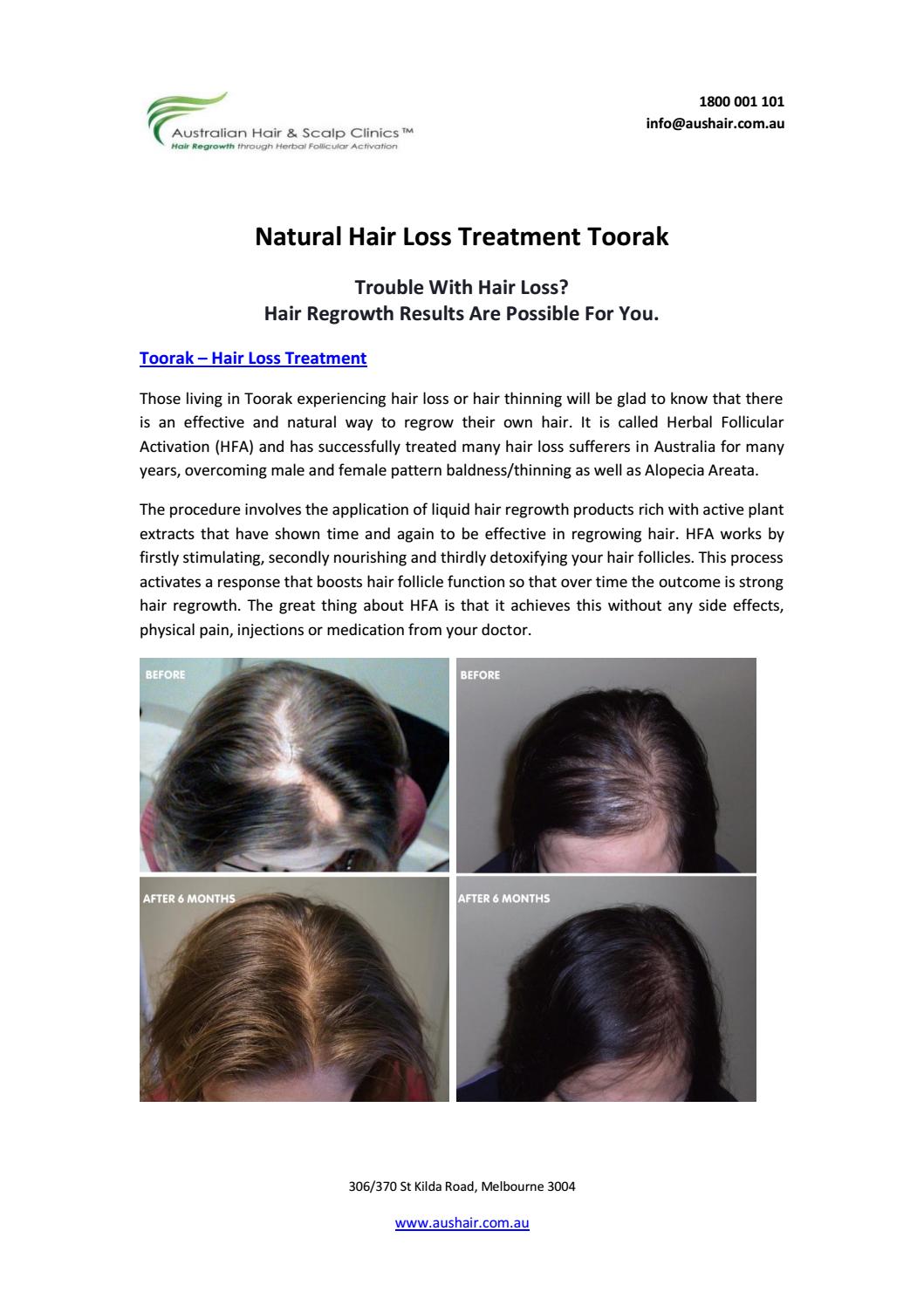 Natural Hair Loss Treatment Toorak by Australian Hair & Scalp Clinic