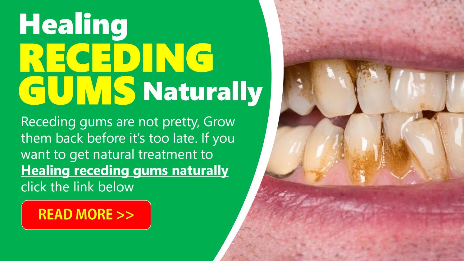 Healing Receding Gums Naturally by WillieWilcox - Issuu