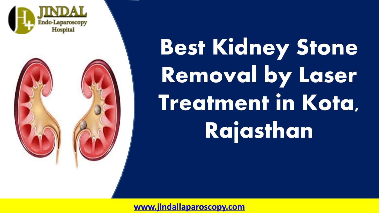 Best Kidney Stone Removal By Laser Treatment in Kota, Rajasthan by