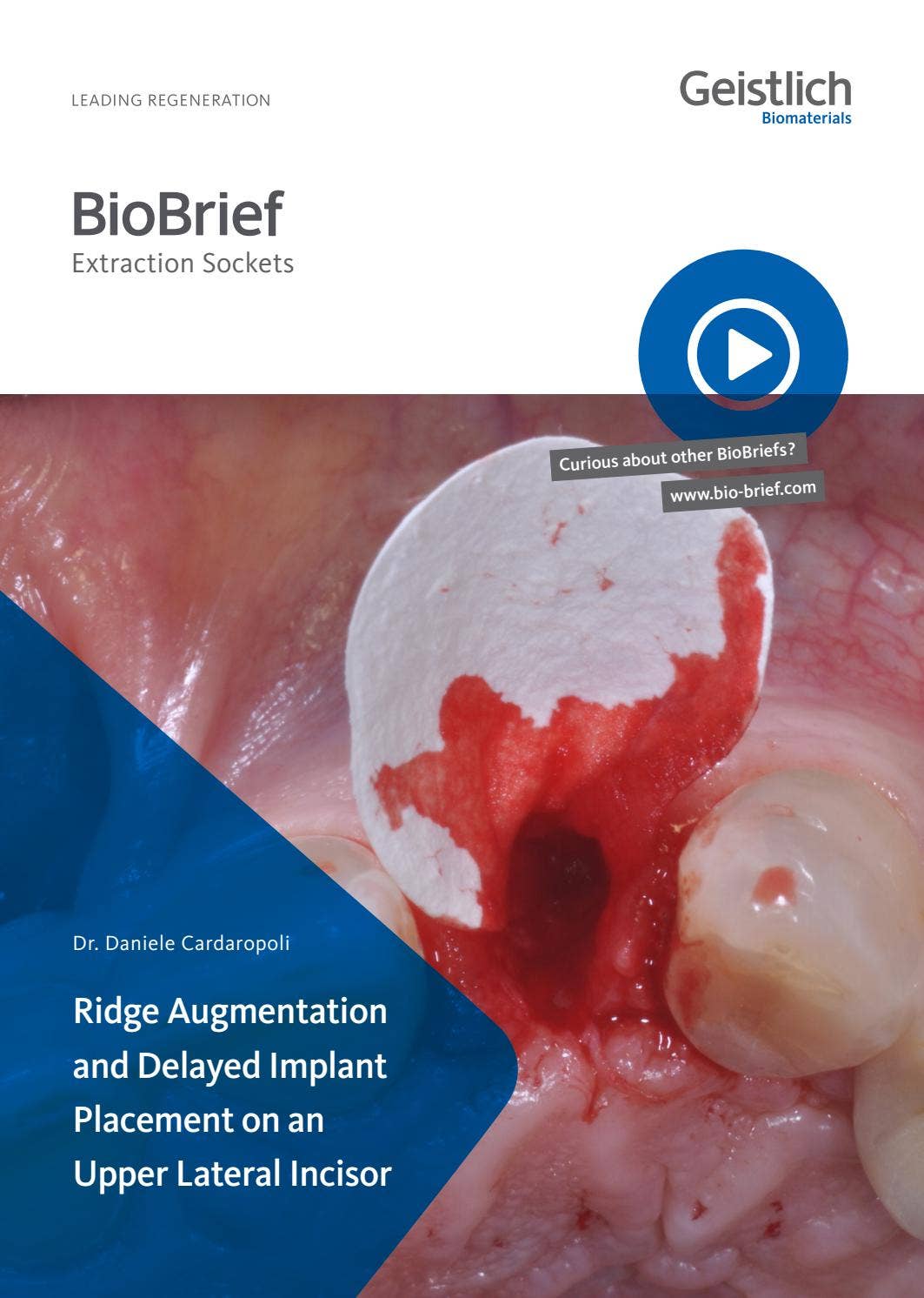 Upper Ridge Augmentation Ridge Augmentation and Delayed Implant Placement on an Upper Lateral ...