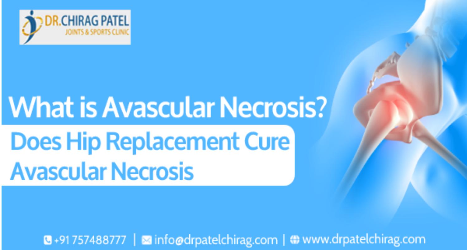 Causes and Risk Factors for Avascular Necrosis Best Joint Replacement