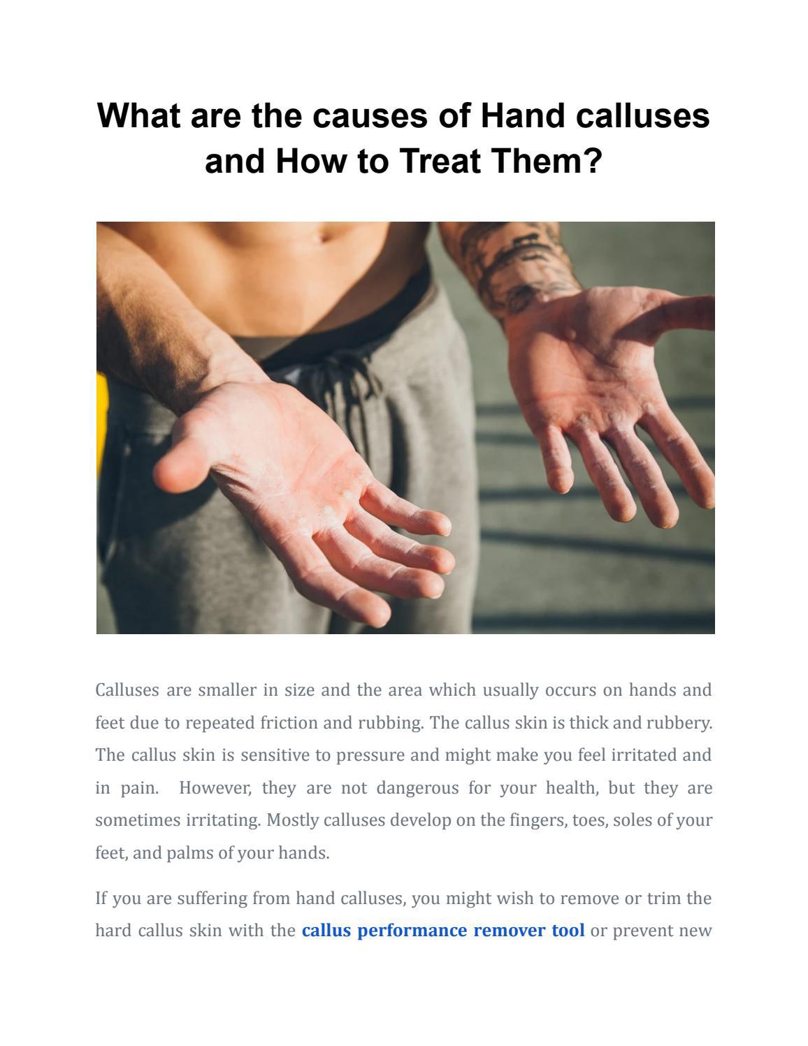 what-are-the-causes-of-hand-calluses-and-how-to-treat-them-by