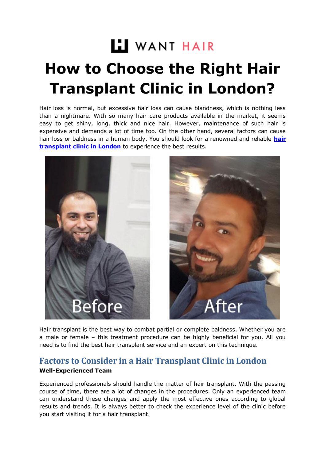How to Choose the Right Hair Transplant Clinic in London? by Want Hair