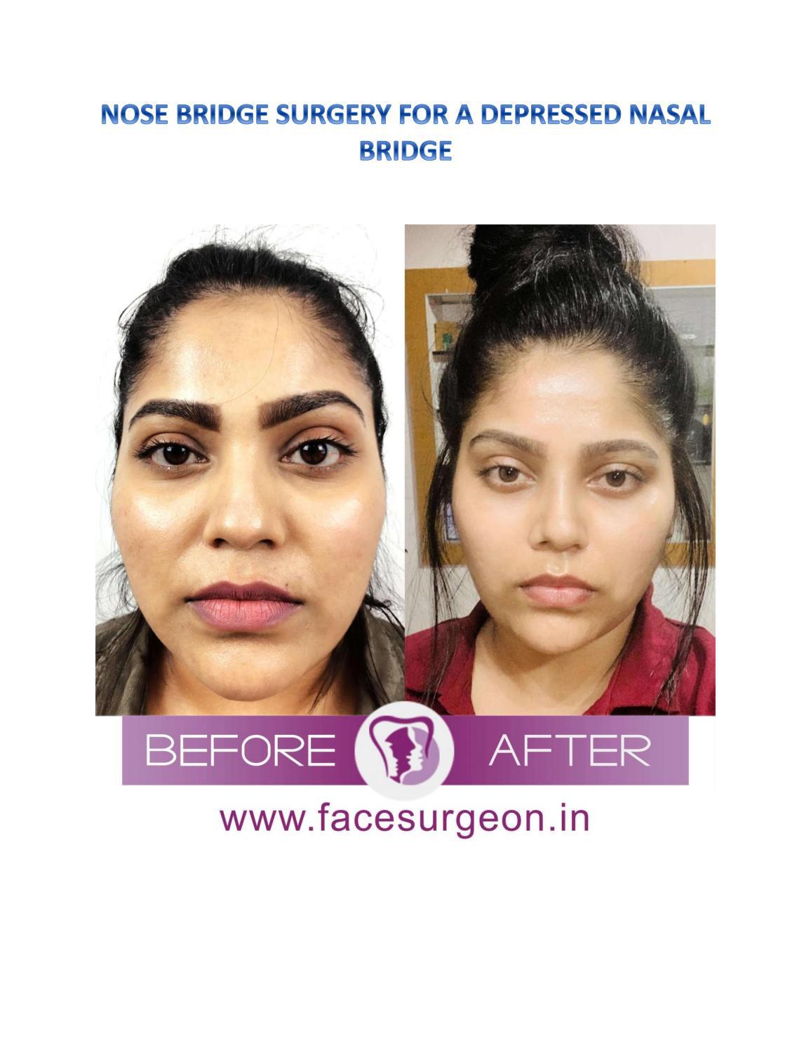 Nose Bridge Surgery for a depressed nasal bridge by Richardsons Dental