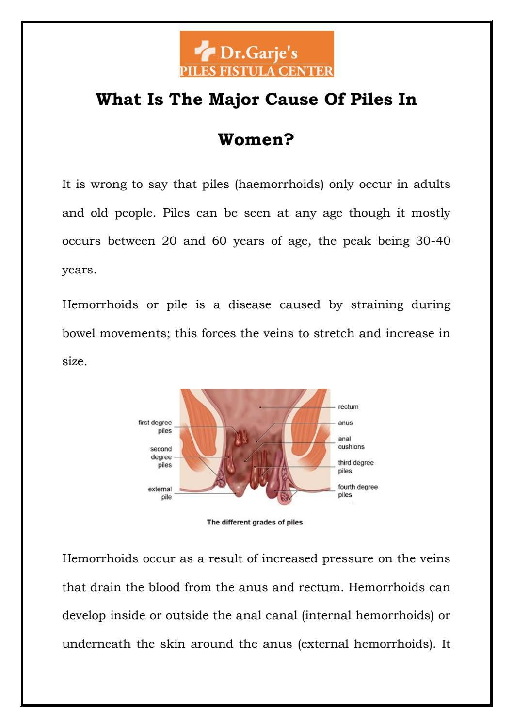 What Is The Major Cause Of Piles In Women? by Dr Garje's Piles Fistula