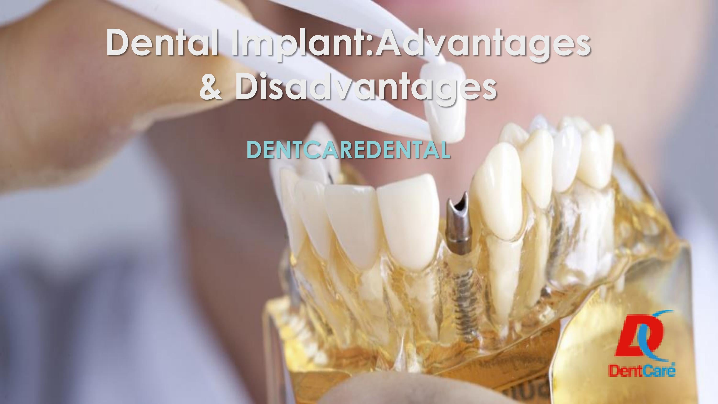 Dental Implant Advantages and Disadvantages by dentcare dental Issuu