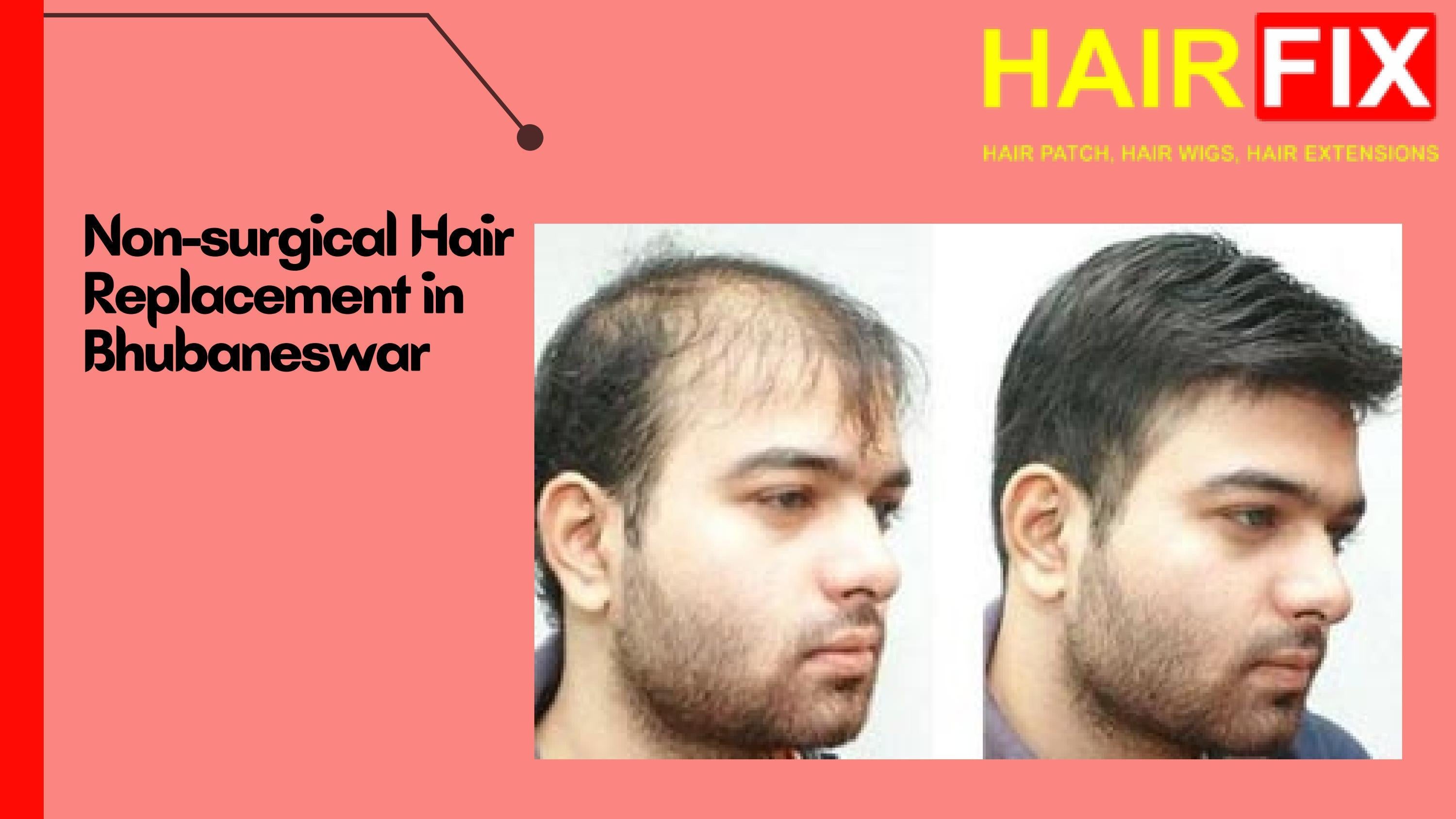 NonSurgical Hair Replacement in Bhubaneswar by hairfixsolution Issuu