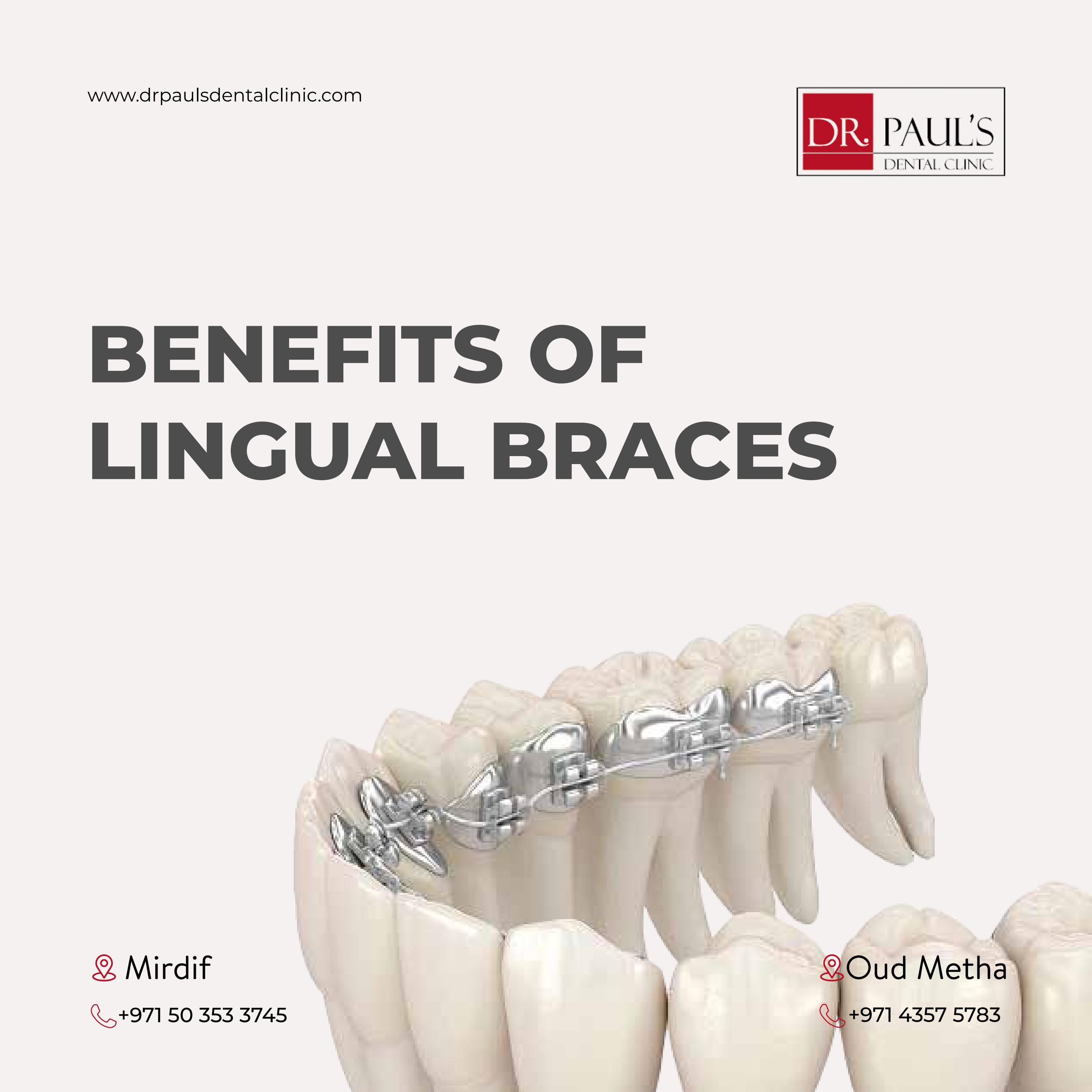 Benefits Of Lingual Braces Orthodontic Treatment Dubai by Vivek Thandiakkal Issuu