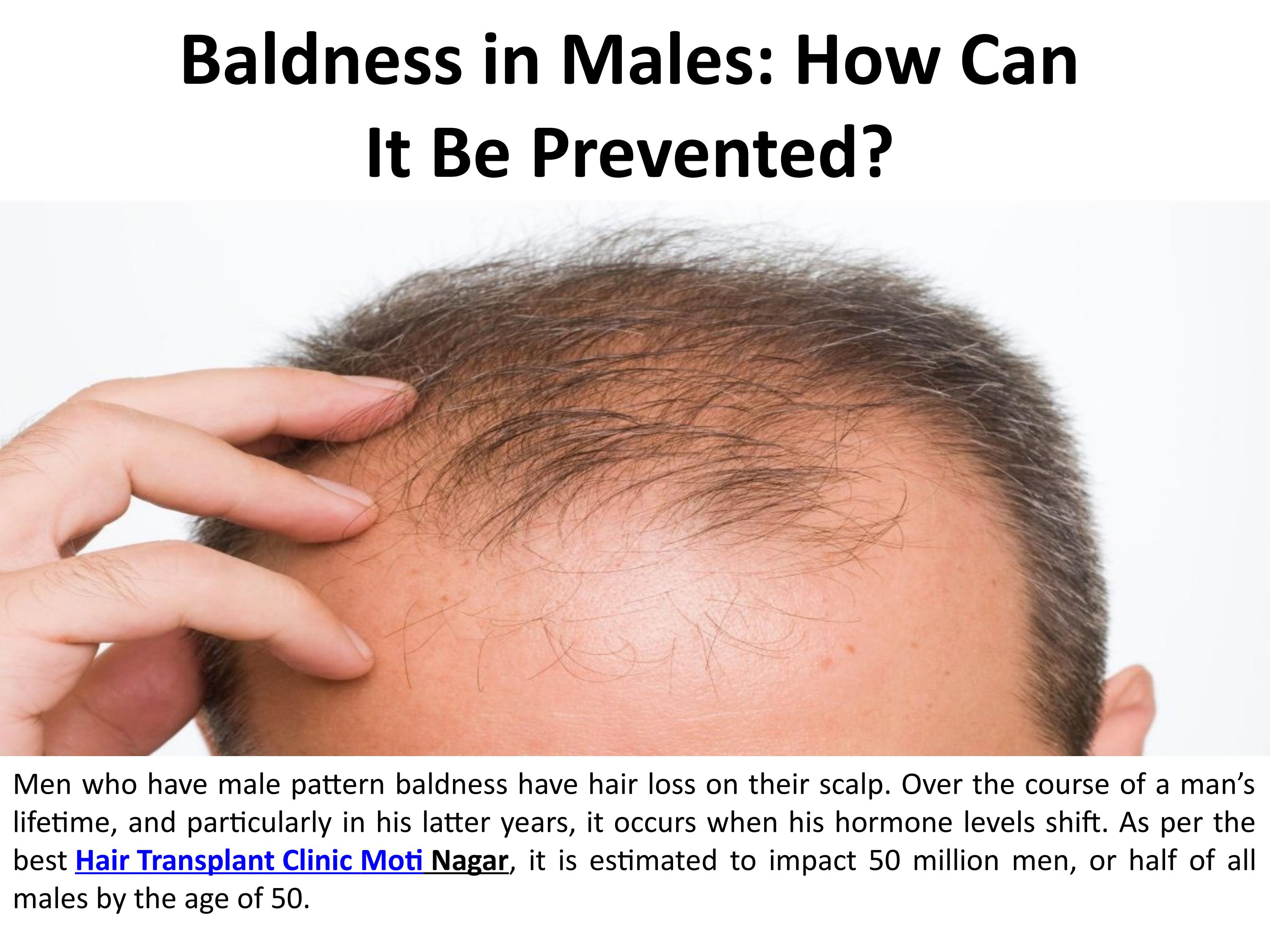 Baldness in men How might it be stopped? by B Vertex Care Issuu