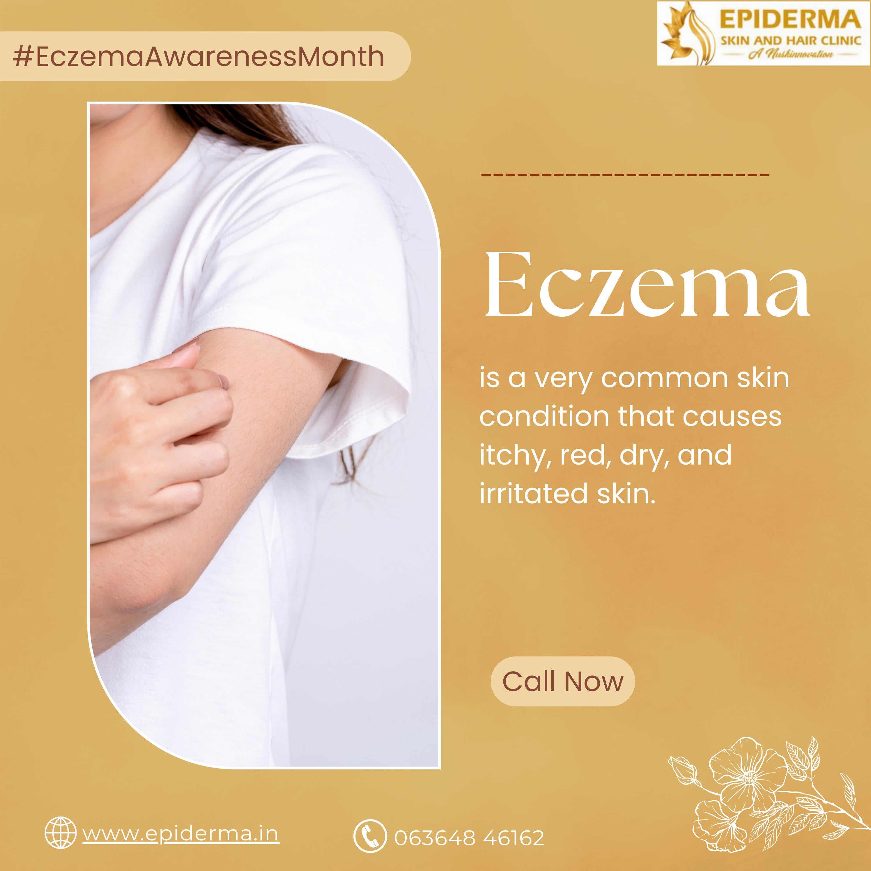 What is Eczema Best Skin Clinic in Jayanagar Epiderma Clinic by