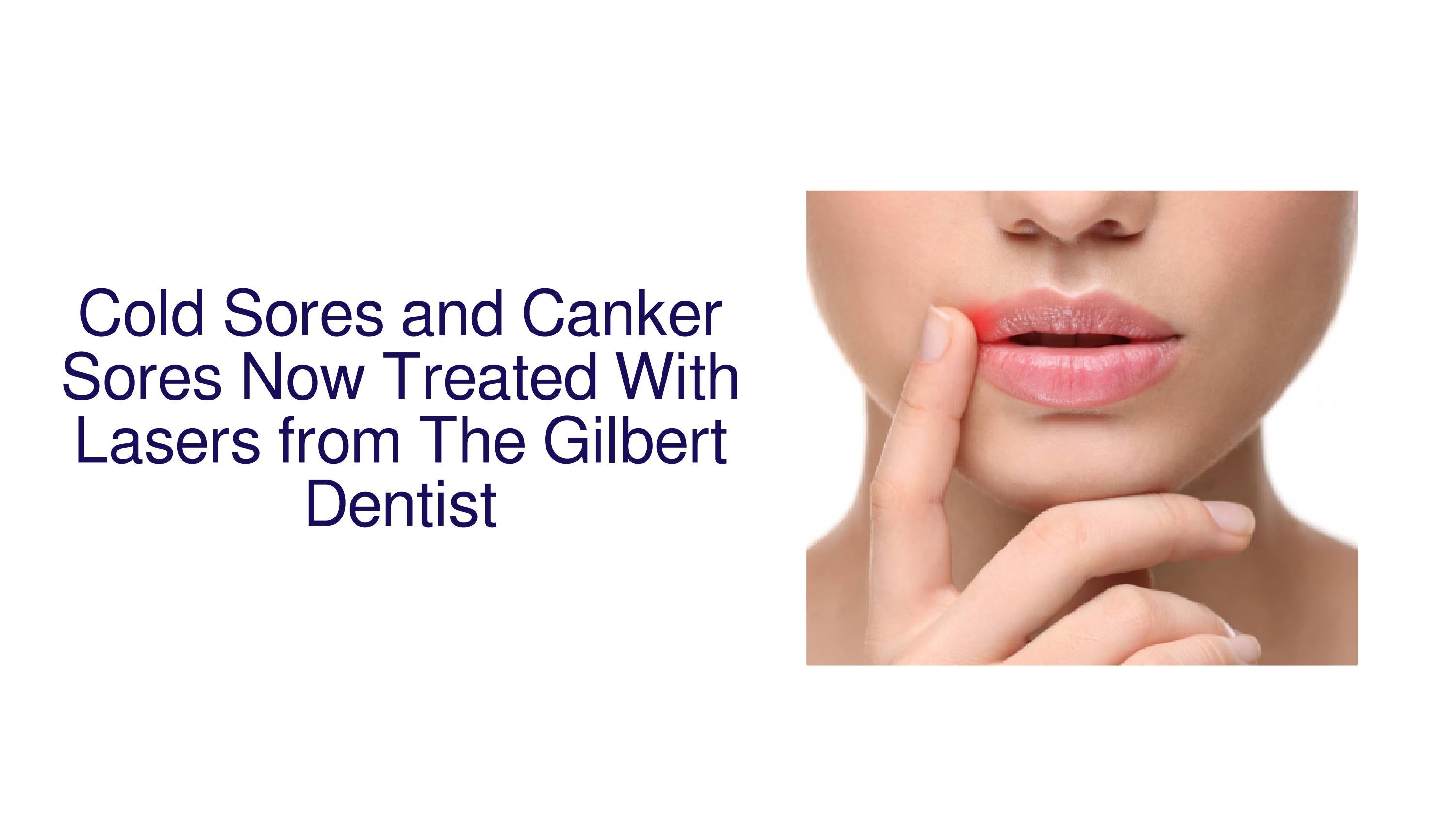 Cold Sores and Canker Sores Now Treated With Lasers from The Gilbert