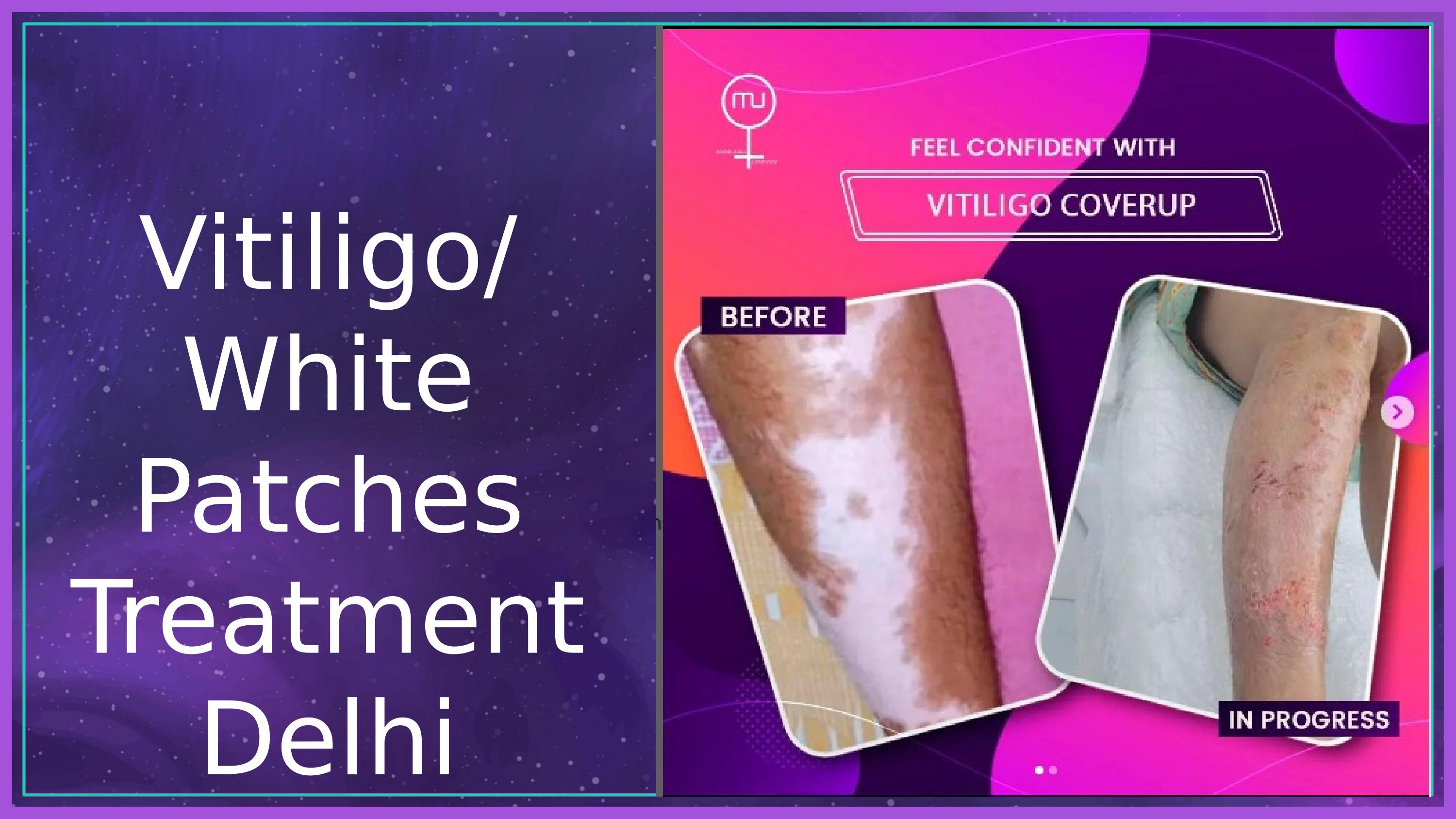 White Patches Treatment Delhi By Madhulika Upadhyayy Issuu White Patches Treatment Delhi By Madhulika Upadhyayy Issuu