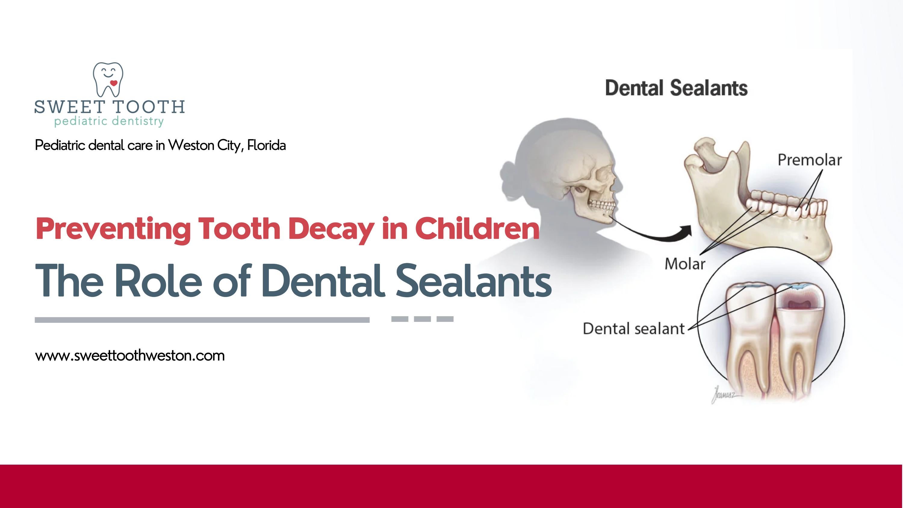 Preventing Tooth Decay in Children The Role of Dental Sealants by