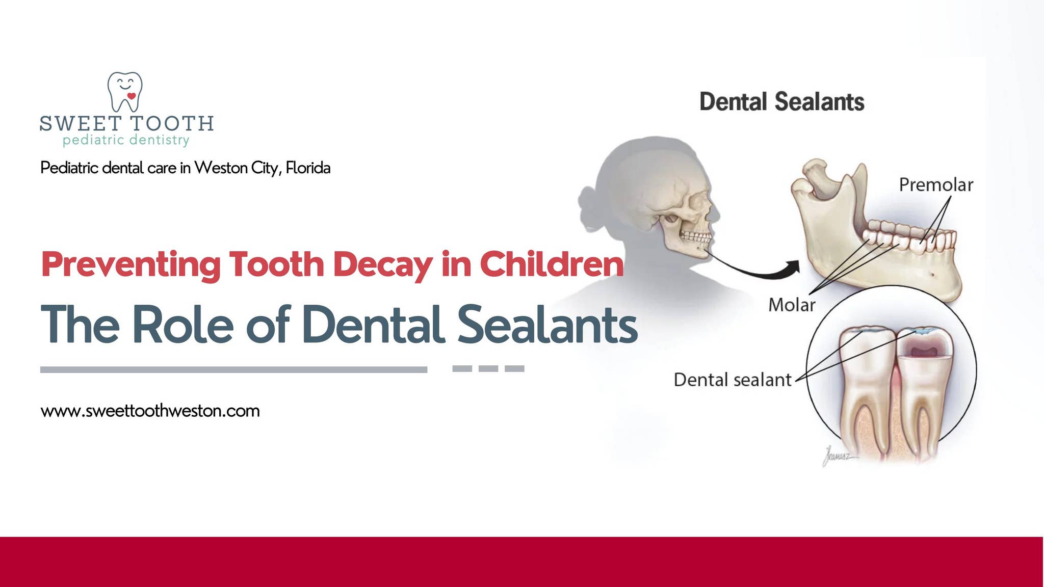 Preventing Tooth Decay in Children: The Role of Dental Sealants by ...