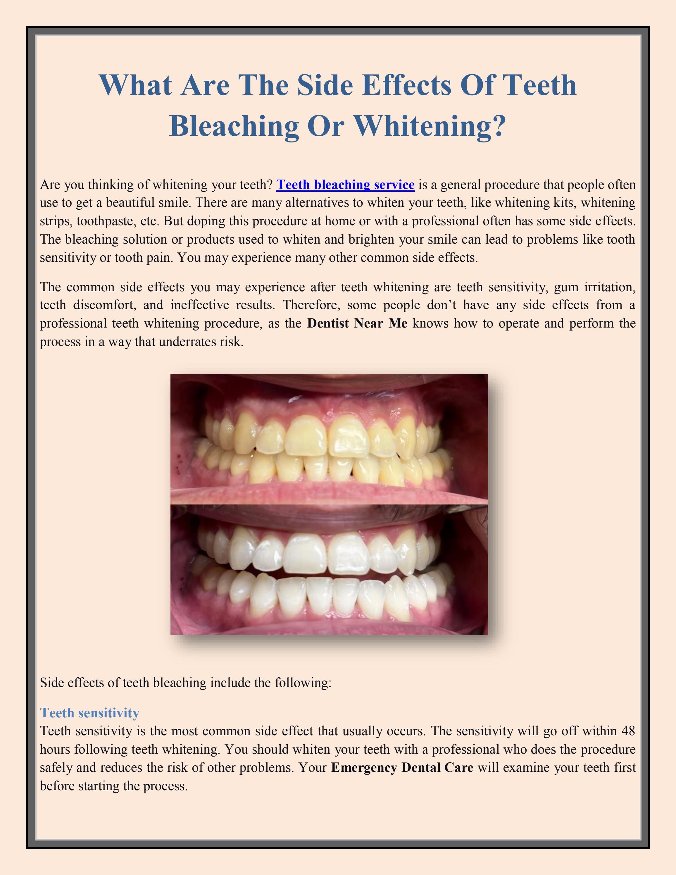 What Are The Side Effects Of Teeth Bleaching Or Whitening? by Emergency
