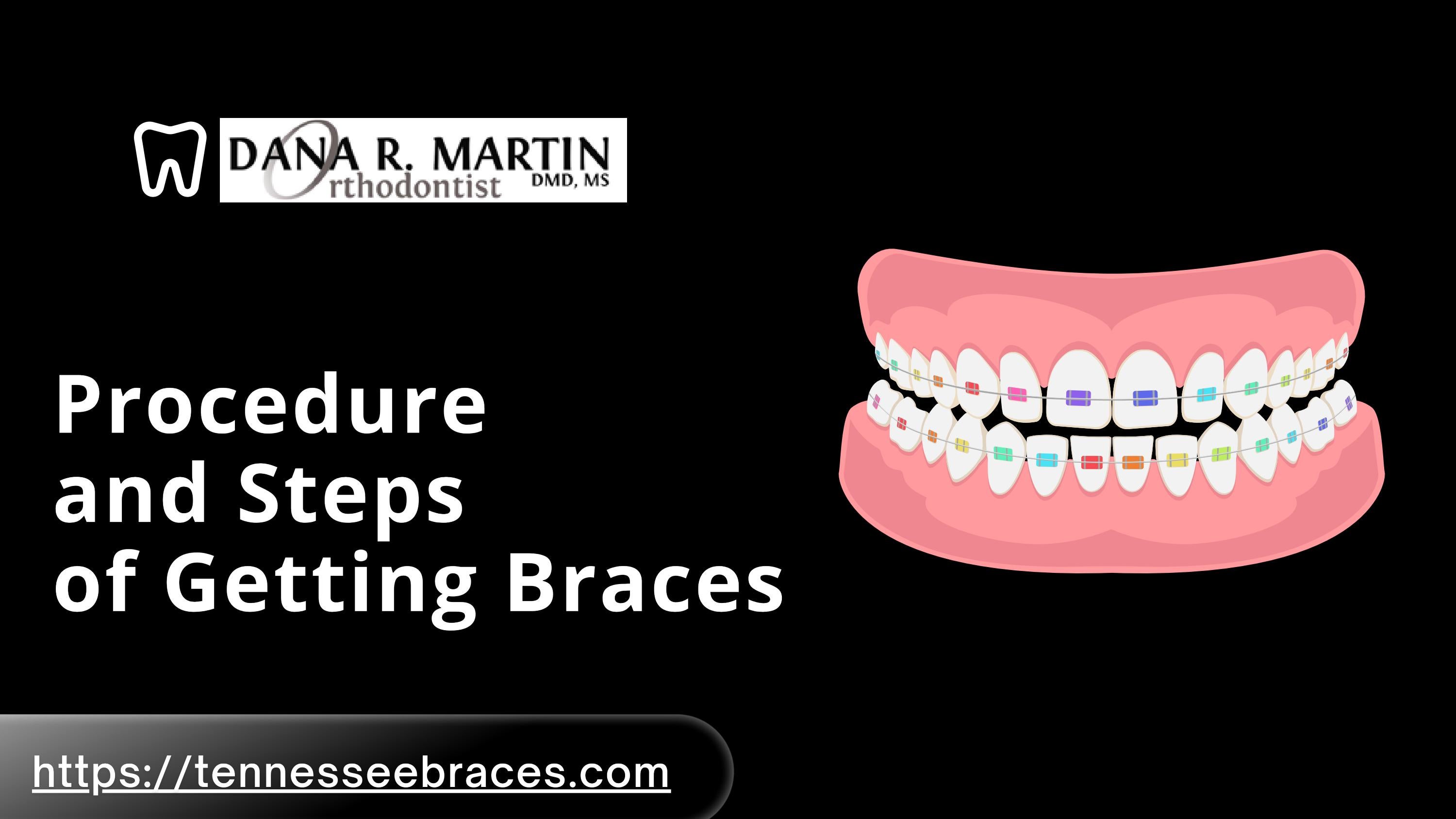 StepbyStep Guide Getting Braces What to Expect and How to Prepare