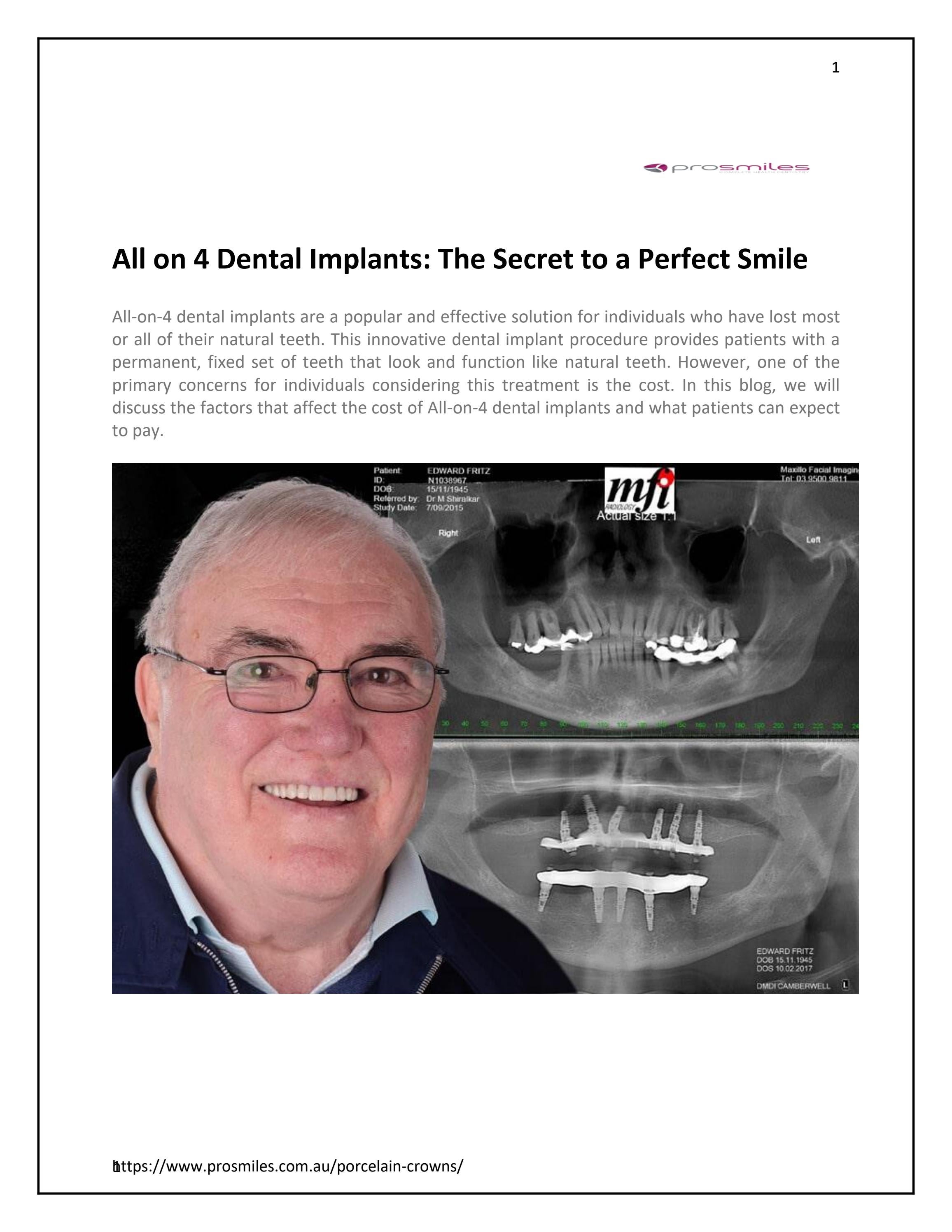 All on 4 Dental Implants The Secret to a Perfect Smile by Pro smiles