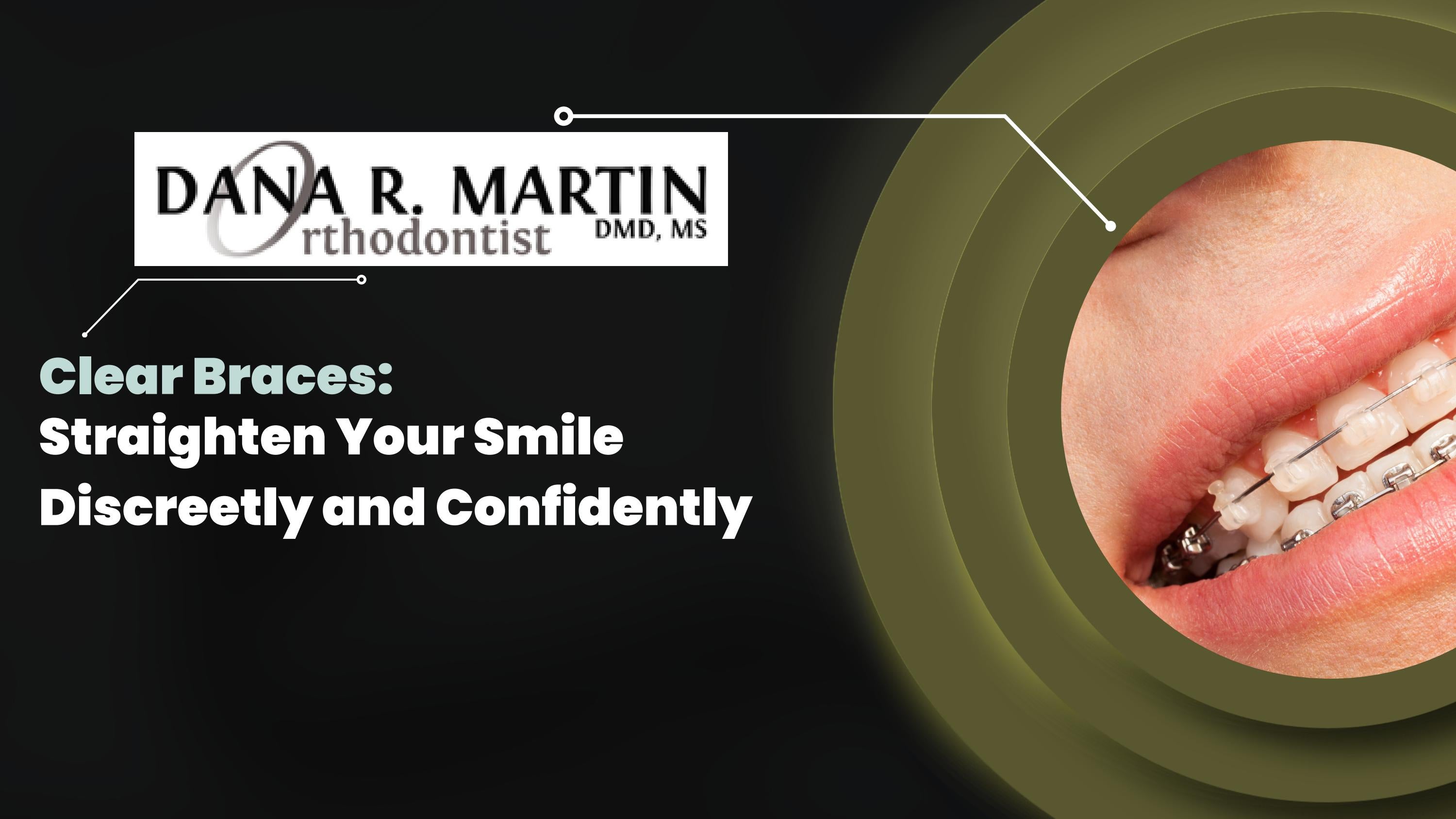 Clear Braces Achieve a Confidently Straight Smile with Discretion by