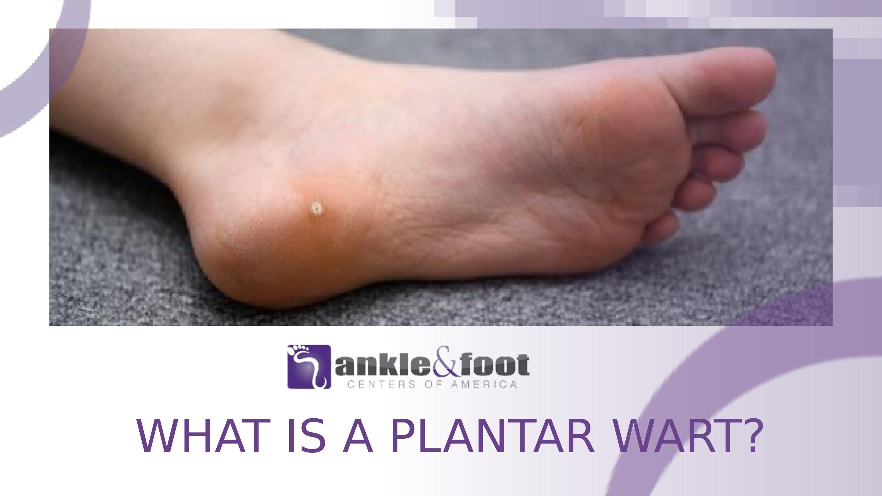 What is a Plantar Wart? by Ankle & Foot Centers of America Issuu