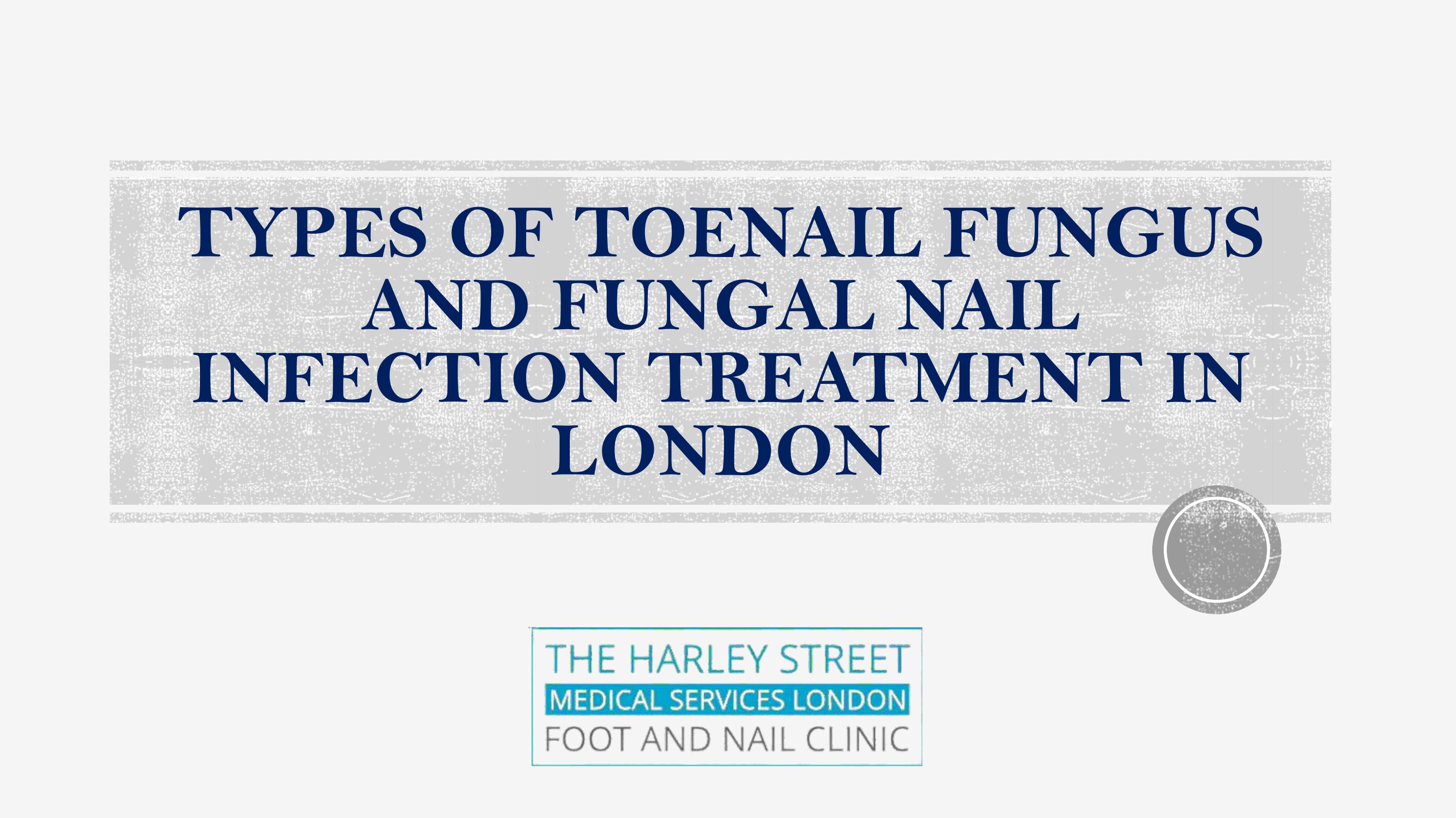 Types Of Toenail Fungus And Fungal Nail Infection Treatment In London