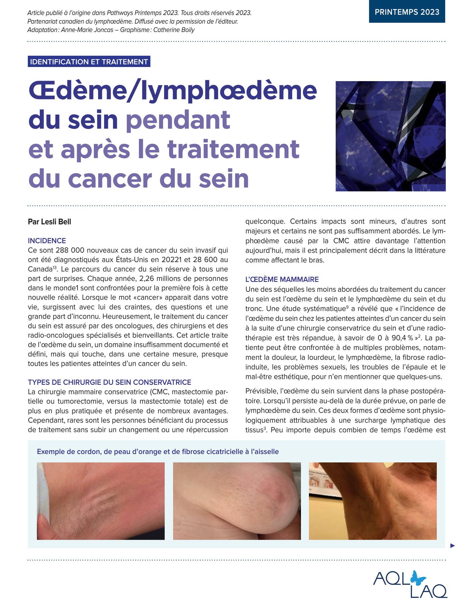 Oedème mammaire by Association québécoise du lymphœdème/Lymphedema ...