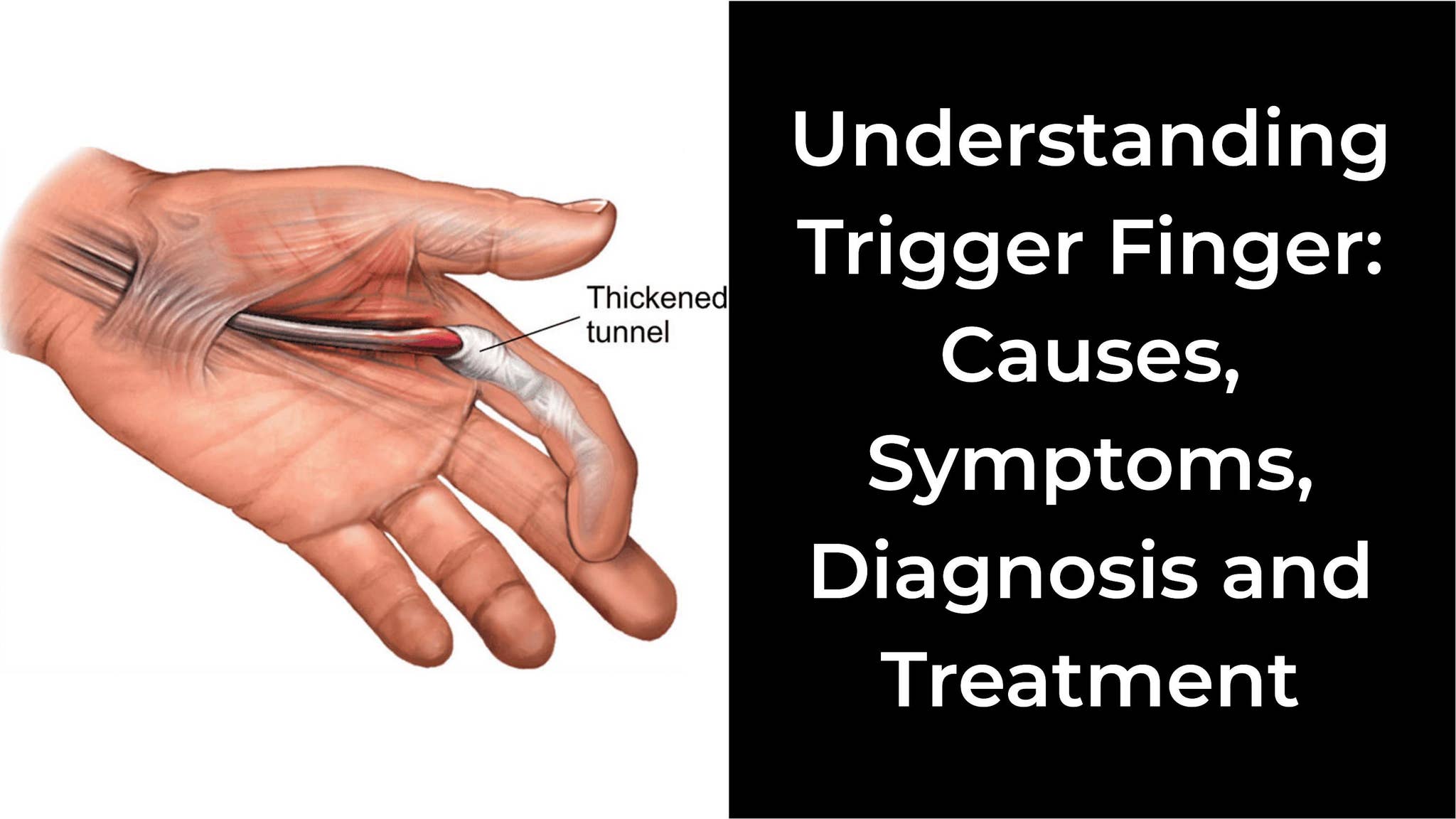 Understanding Trigger Finger Causes, Symptoms, Diagnosis and Treatment ...