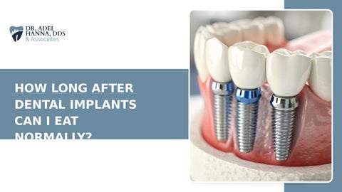 Dental Implant Healing Timeline: When Normal Eating Becomes Safe Again
