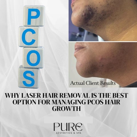 PCOS & Laser Hair Removal 