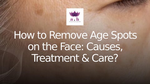 How to Remove Age Spots on the Face Causes, Treatment & Care