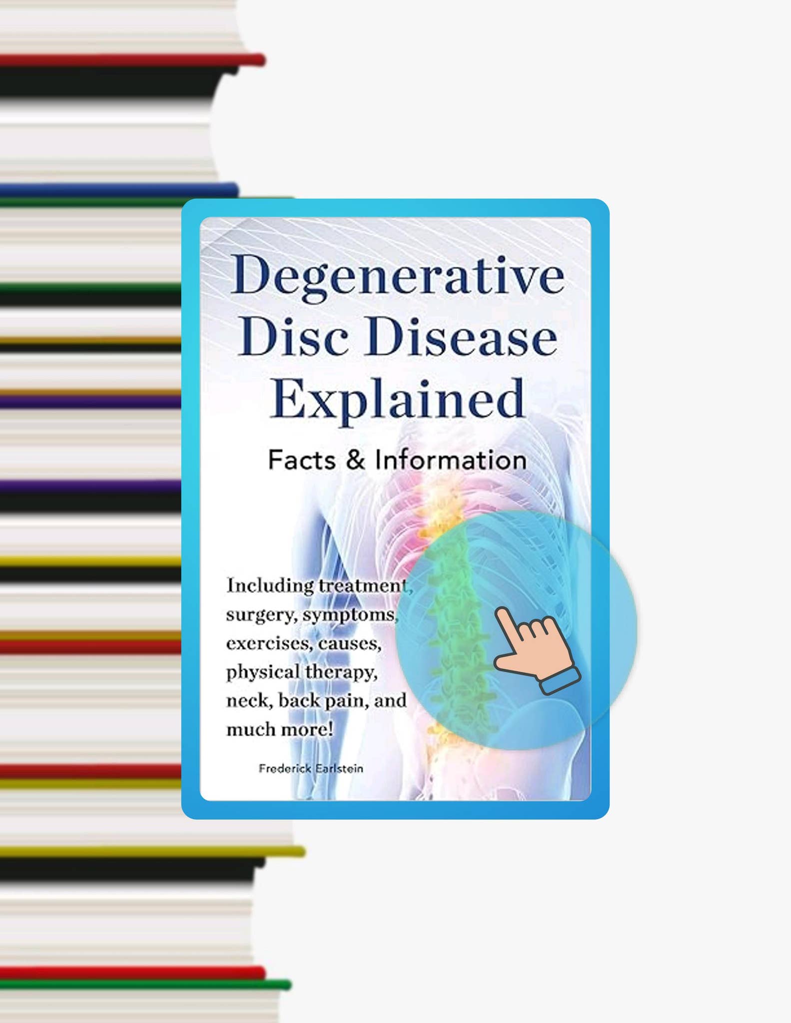 PDF Degenerative Disc Disease Explained. Including Treatment, Surgery ...