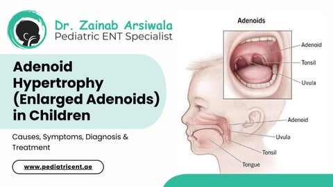 Adenoid Hypertrophy (Enlarged Adenoids) in Children